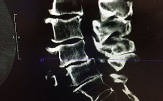 A Review of Conservative Options in the Treatment and Management of Lumbar Spinal Stenosis